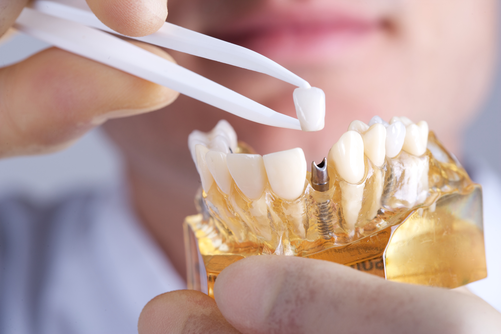 implantes dentales Valladolid