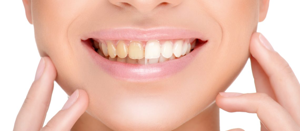 part of the face with healthy and bad teeth close-up