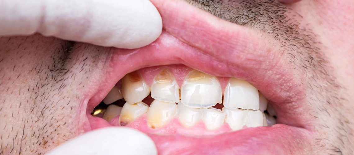 ¿Qué es la hipoplasia dental? | Clínica Recaver