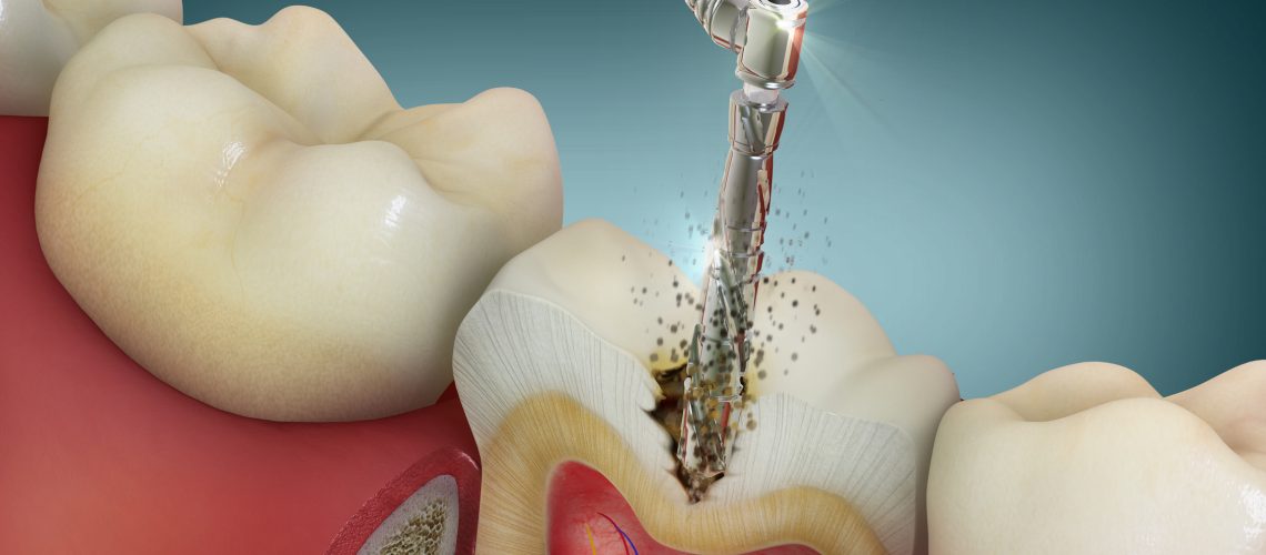 Advanced dental drill in action…Damaged tooth treatment. 4D illustration.