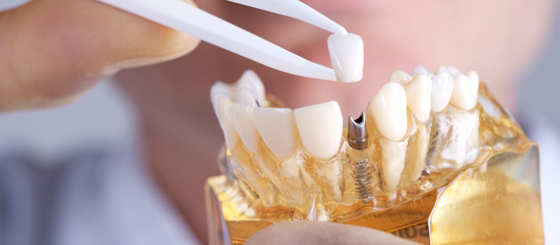 doctor holding model with dental implant. He is holding the synthetic tooth between forefinger and thumb.